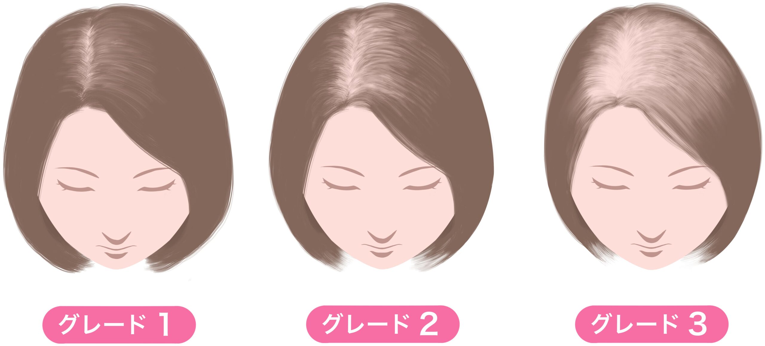 女性の薄毛（FAGA） | さっぽろ白石皮膚科クリニック｜札幌白石